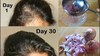 Regrow Lost Hair From Roots With Onion Juice & Coconut Hair Oil - Double Hair Growth & Get Long Hair