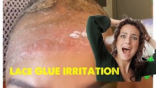 Scalp Irritation And Lace Glue