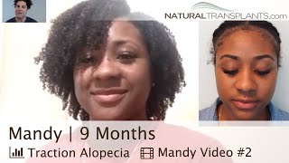Black Hair Transplant Before And After | Black Hair Transplant Specialist (Mandy)