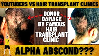 Youtubers Vs Hair Transplant Clinics | Donor Damage | New Clinic Closed | Hsn 2.0 Hair Transplant