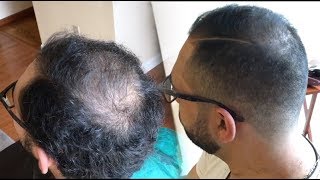 How To Cut And Fade Balding Hair