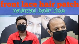 Front Lace Hair Patch | Hair Patch Highlight Color | Hair Wig In Delhi | Best Hair Fixing 9599858612