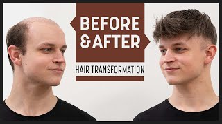 Tired Of Adhering Your Front? This Is Your Look | Transformation With Hair Piece