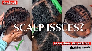 Dandurff? Dermatitis? Scalp Issues? | Watch This! + Husband/Male Natural Hair Wash Day