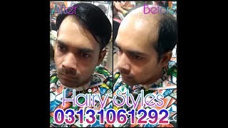 Hair Replacement In Karachi With Best Quality In Karachi_Hairy Styles| Whatsapp: +923402666086