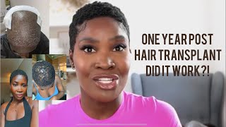 One Year Post Hair Transplant? Did It Work?!