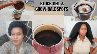 How To Stop Hair Loss, Alopecia Fast & Grow Bald-Spots  || Natural Dht Blocker| { *10X Longer Hair*}