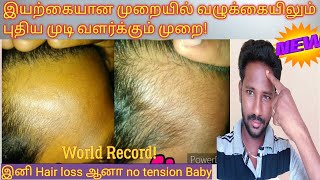 Hair Loss Treatment 2021 | Hair Research Tamil | Aticy Ennnney | Hair Loss Solutions |Kingtash Tamil