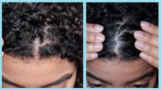 How To: Remove Dandruff With Apple Cider Vinegar | Natural Curly Hair