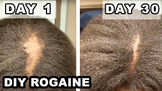 How I Fixed My Bald Spot. | Diy Rogaine On 4C Natural Hair